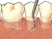 Parodontitis-Kürettage